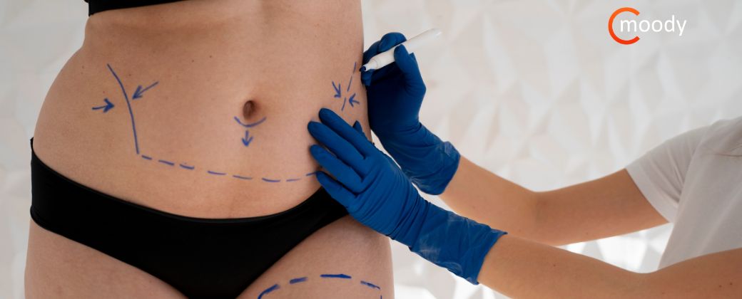 איך לבחור מנתח לשאיבת שומן – קריטריונים חשובים לפני החלטה